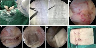 A single-arm retrospective study of the clinical efficacy of unilateral biportal endoscopic transforaminal lumbar interbody fusion for lumbar spinal stenosis